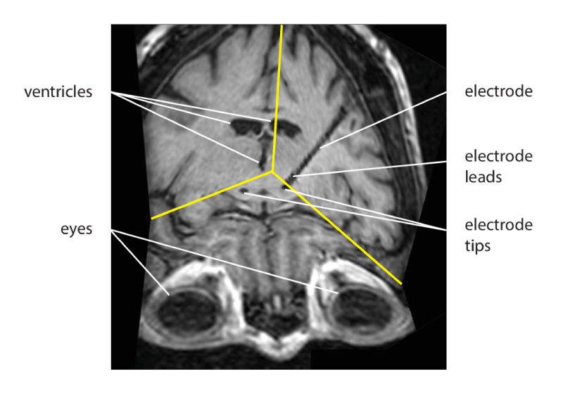 MRI image of a patient’s brain, showing the placement of the electrodes in relation to the eyes and ventricles.