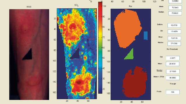 Hyperspectral images from The University of Nottingham, derived by shining light on the tissue surface and accurately measuring oxygen levels and generating oxygen saturation maps to facilitate the work of clinical researchers and doctors.