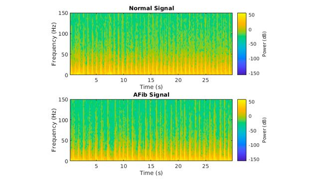 Classify ECG Signals Using Long Short-Term Memory Networks