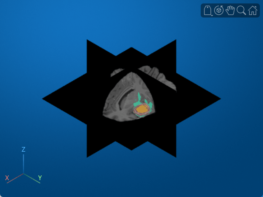 Brain MRI displayed using slice planes, with the tumor label overlays