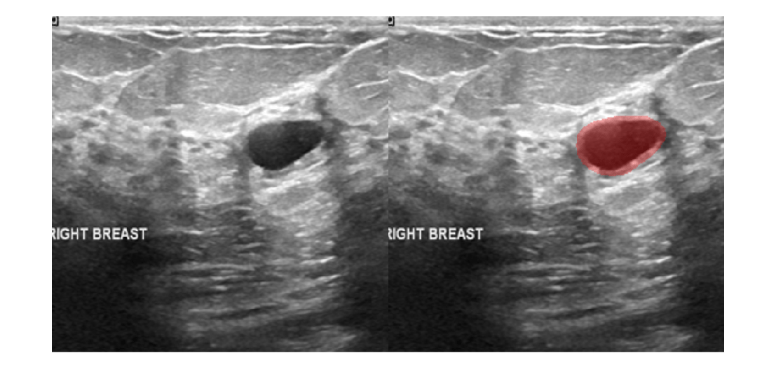 Breast Tumor Segmentation from Ultrasound Using Deep Learning