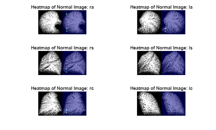 Detect Irregularities in 3-D Volumetric Lung CT Data Using PatchCore Anomaly Detector