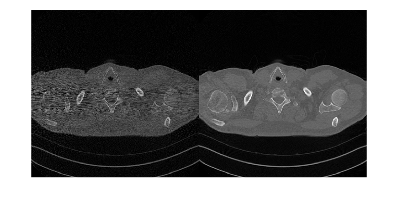 Unsupervised Medical Image Denoising Using UNIT